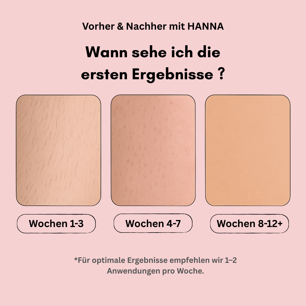 Hanna's IPL Hair Remover – Dauerhaft glatte Haut in 8 Wochen
