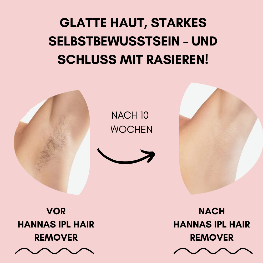 Hanna's IPL Hair Remover – Dauerhaft glatte Haut in 8 Wochen