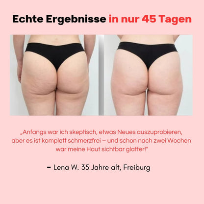 Hanna Sculpt – 3in1 Anti-Cellulite System