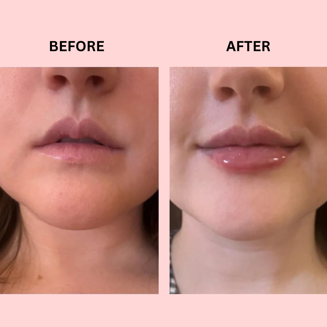 Hanna LipBoost Set – Naturally Fuller Lips Without Injections