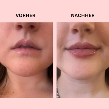Hanna LipBoost Set – Sichtbar vollere Lippen in nur wenigen Wochen – ganz natürlich & ohne Spritzen.